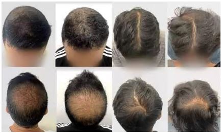 탈모치료제-판시딜