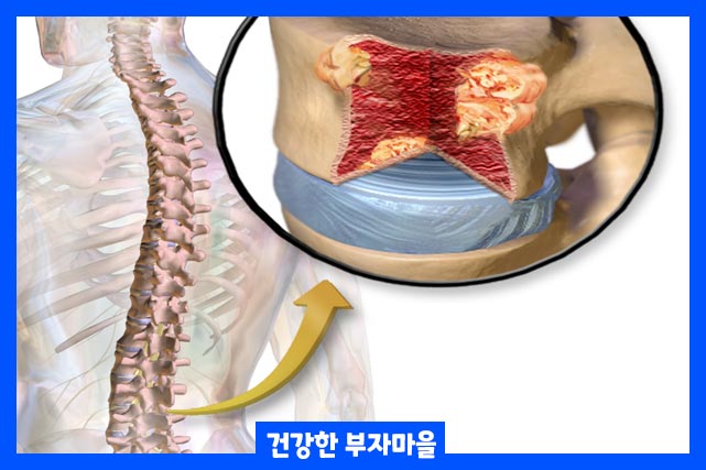 생존기간은 사람마다 다르지만 치료를 통해 5년 이상 생명을 연장할 수 있습니다.