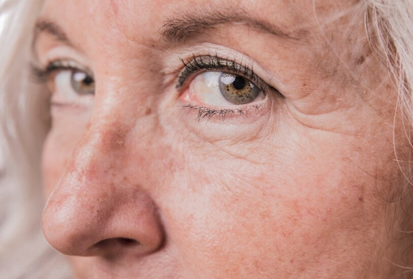 백내장이 온 할머니