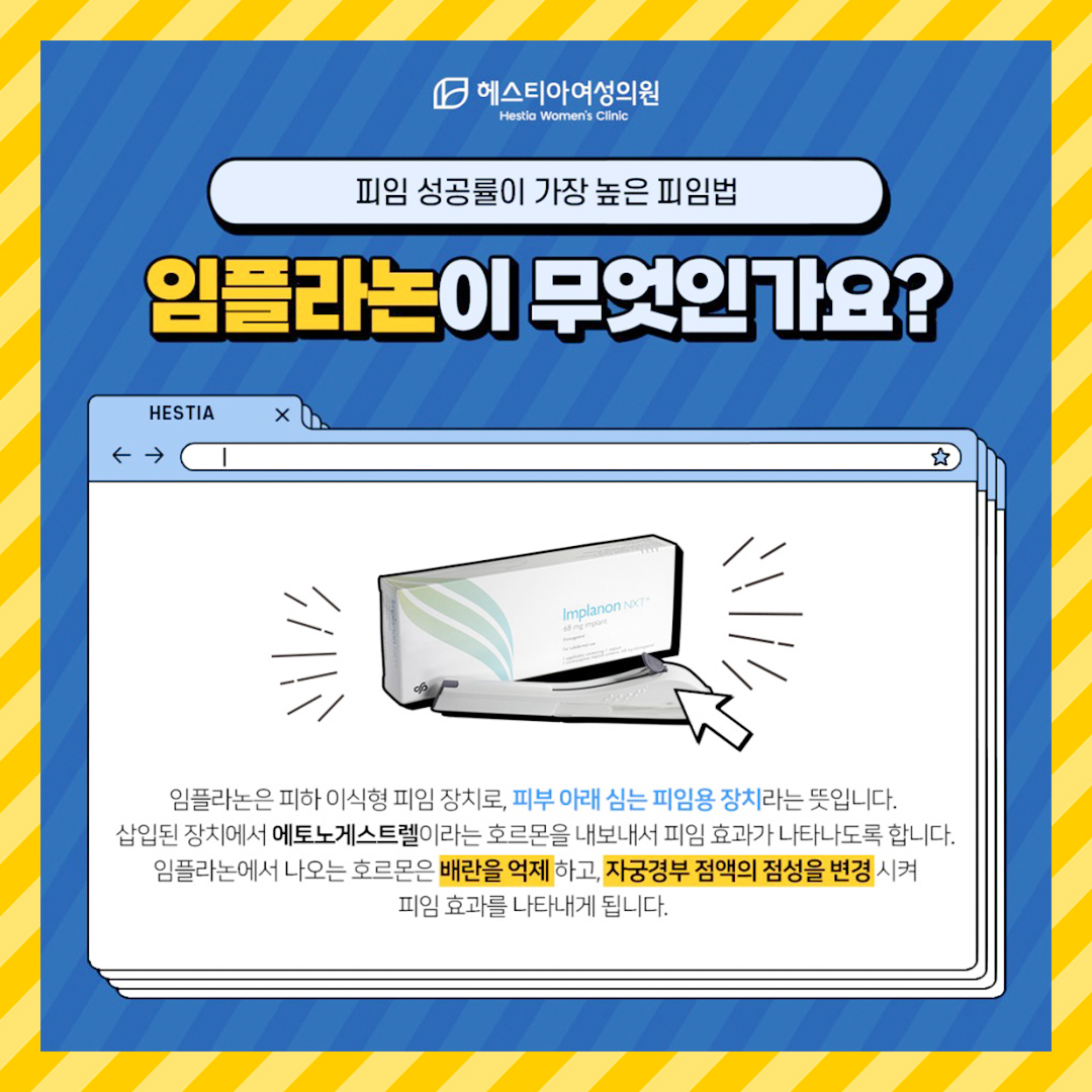 임플라논이 무엇인가요?