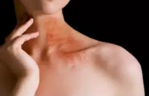 대상포진에-좋은-음식-대상포진-치료법-건강