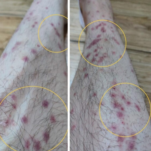 빈대 물린자국3