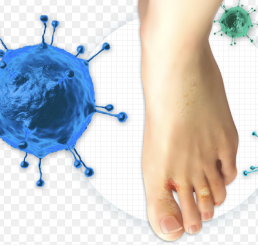 사마귀 제거방법 17