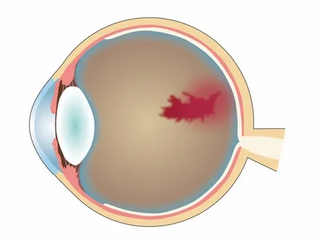 비문증-원인-날파리증- 광시증-왜-생기는-걸까?-비문증-자연치유-부터-치료-방법까지-확인하기