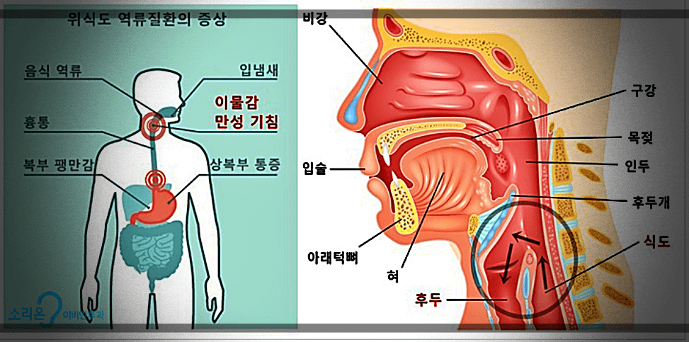 위식도-역류질환-증상-위치