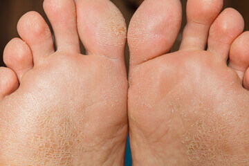 발바닥 껍질 벗겨짐 원인은?&amp;#44; 발바닥은 지속적인 충격을 받는 부위로 심장에서 가장 멀고 혈액순환이 잘 되지 않는 부위입니다. 일상생활 중 자주 손을 씻고 눈으로 확인하는 부분이지만&amp;#44; 발은 양말이나 신발을 신는 등 자주 눈여겨보지 않는 부분입니다. 그렇다면 왜 발바닥 껍질이 벗겨질까요?
