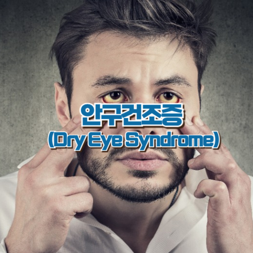 안구건조증(Dry Eye Syndrome)