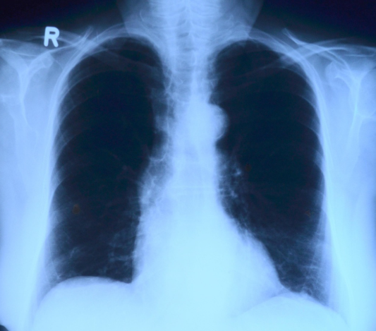 폐 엑스레이 모습