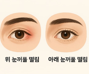 눈떨림 이유와 오래 지속되는 현상 원인