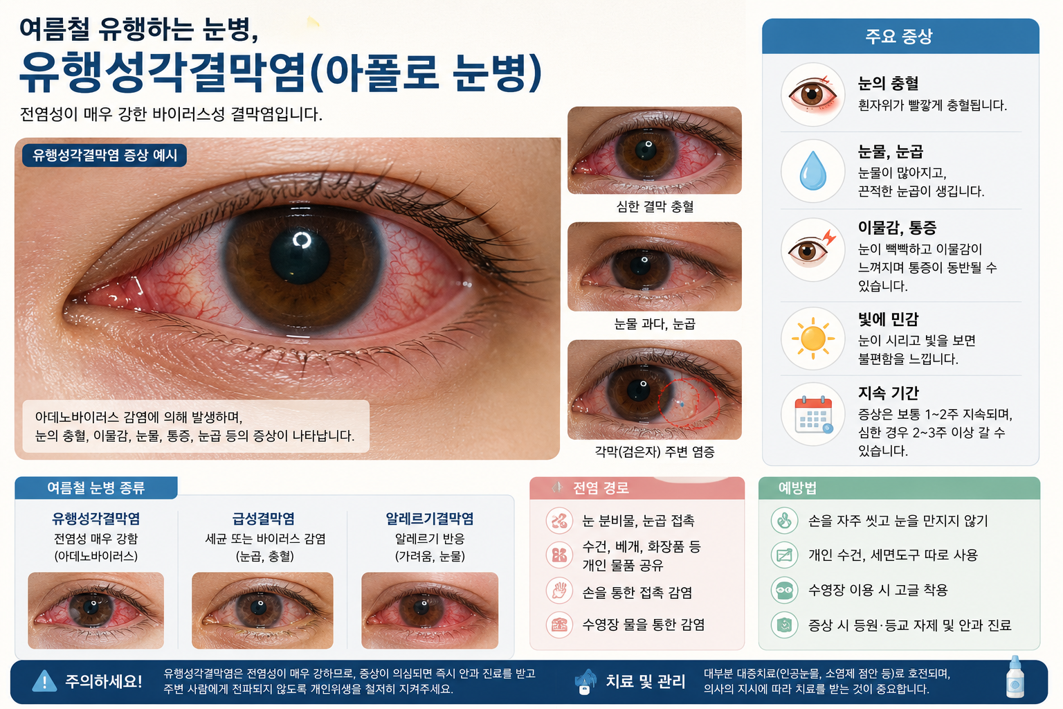 유행성각결막염으로 충혈된 눈, 여름 눈병 증상을 보여주는 이미지