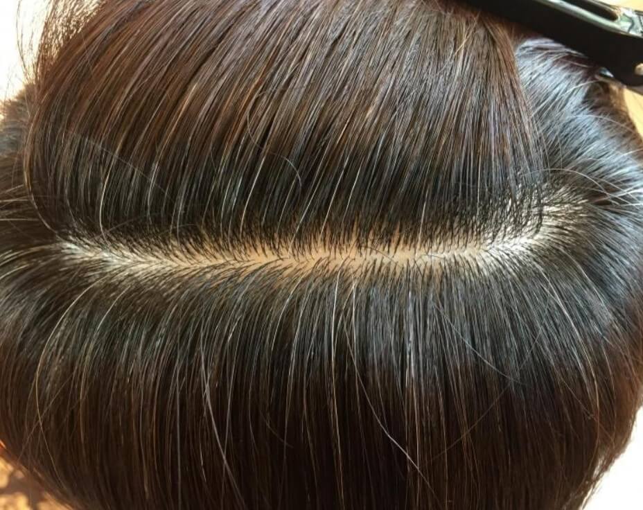 탈모 예방 혈자리