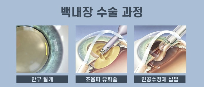백내장 수술과정을 보여주는 그림