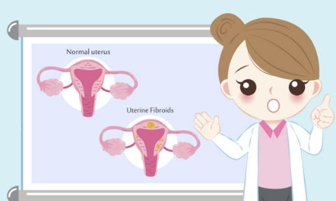 자궁근종 증상 크기별 치료 수술후 회복기간 등 알아보기(최신 Ver)