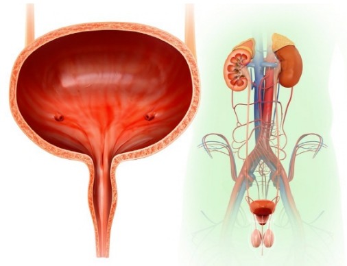 방광암 초기증상 사진