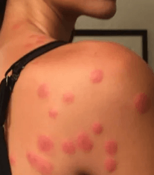 빈대에 물려 여러군데 울긋불긋한 모양