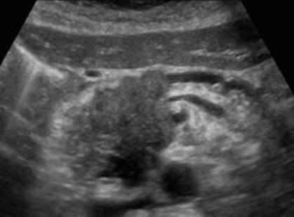 췌두부의 암 (Adenocarcinoma of head of pancreas)