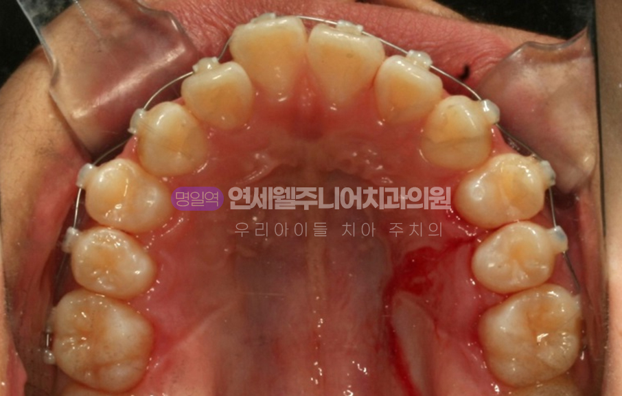MTA 교정 진행 중 와이어로 연결된 상악 치열과 치아 배열 상태를 보여주는 교합면 사진