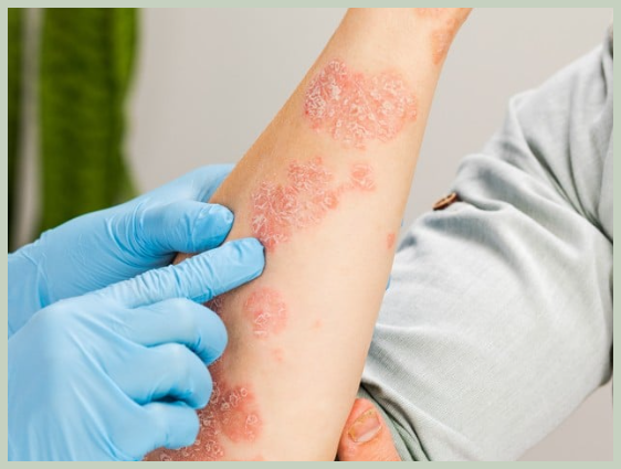 피부묘기증 원인 및 치료법