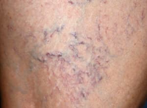 하지정맥류 증상