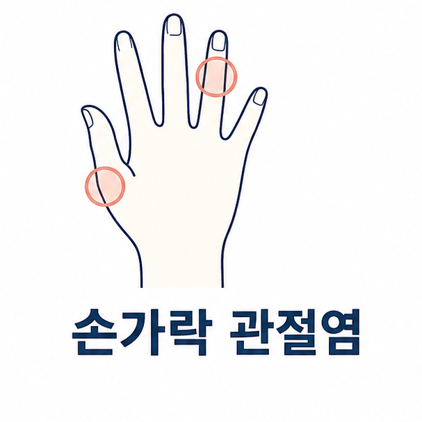 손가락 관절염 대표 이미지, 손을 단순한 선으로 그리고 마디를 표시한 일러스트