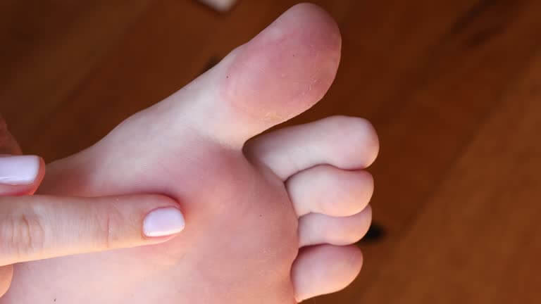 운동 후 발바닥 물집, 터뜨릴까 말까? 올바른 대처법!