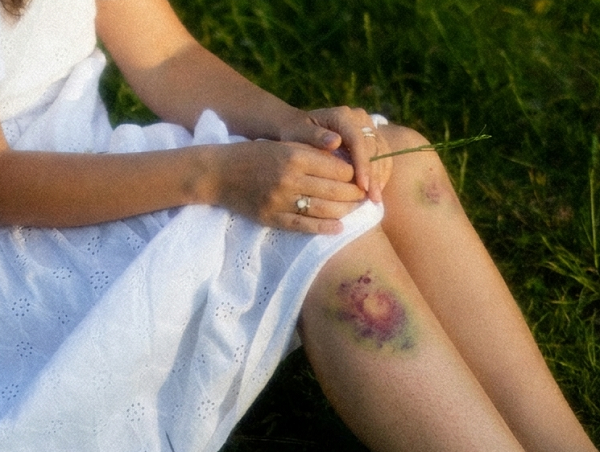 이유 없이 멍이 잘 들어요