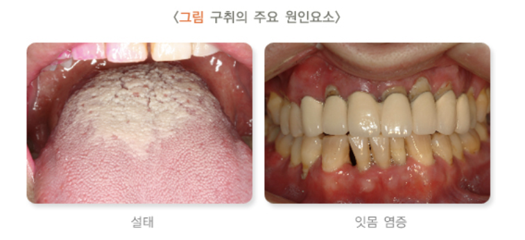 구취의 주요 원인요소