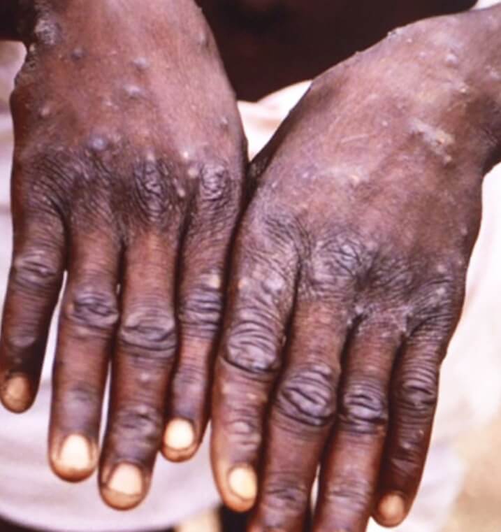 원숭이 두창 관련주 원숭이 두창이란?