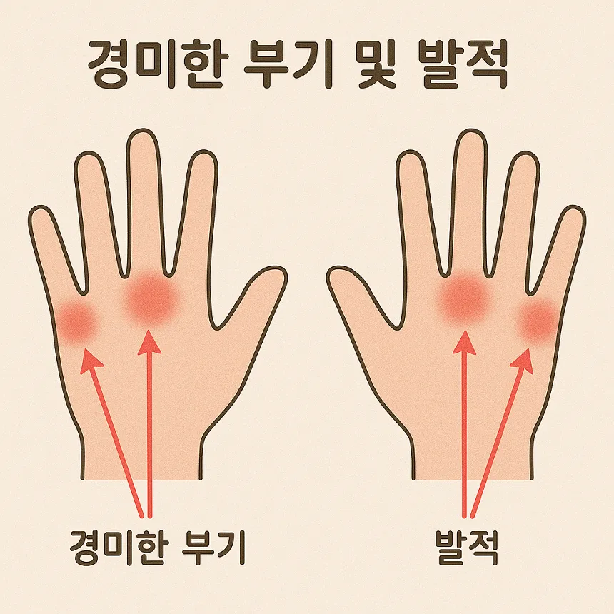 류마티스 관절염 초기증상