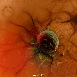 조기 발병 대장암