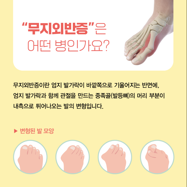 무지외반증(3)