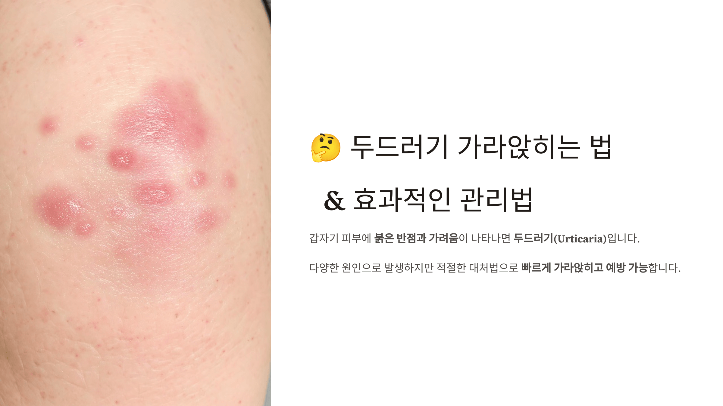 두드러기와 관련된 사진입니다.