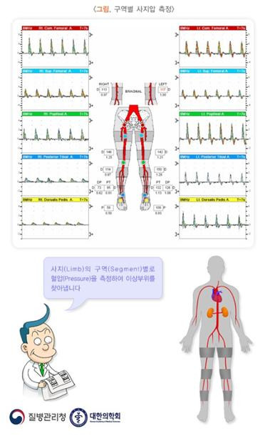 버거병(폐색혈전혈관염)