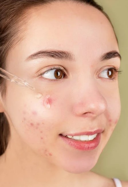 여드름 진정 화장품 제대로 고르는 법! 피부과 추천 성분부터 제품까지 총정리