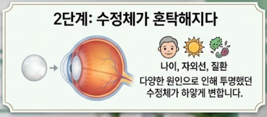 백내장 증상