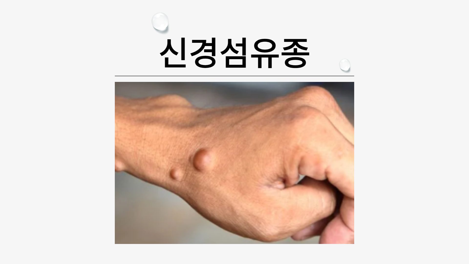 신경섬유종