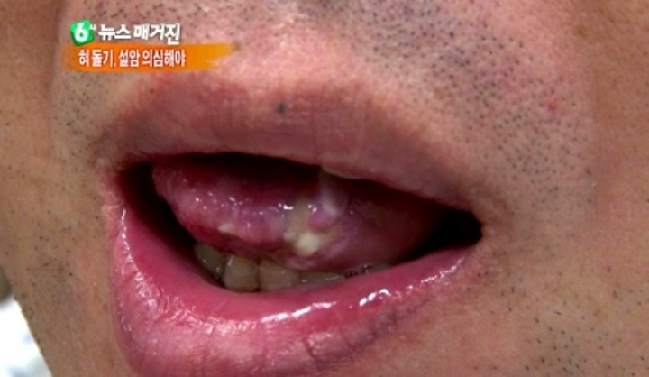 설암