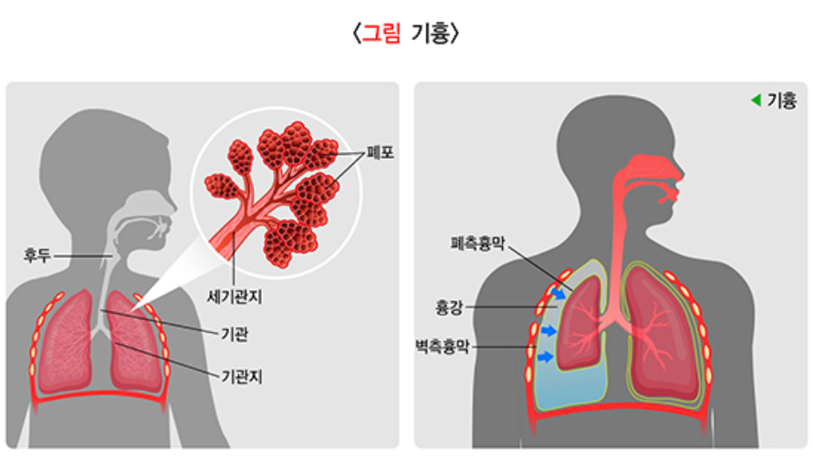 기흉에 대하여