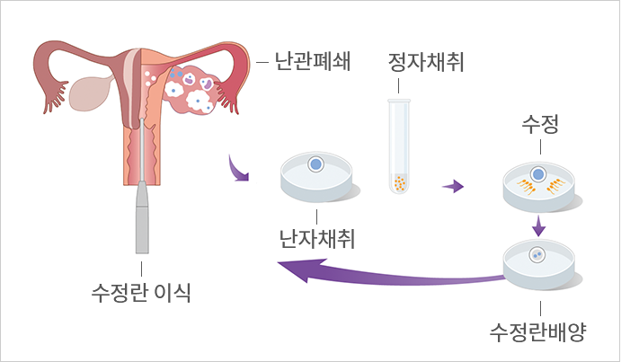 시험관시술 과정