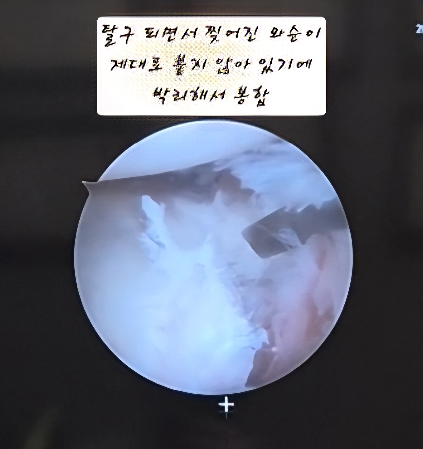 어깨 와순파열 봉합수술 후 mri사진 물리치료 기록