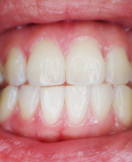 입냄새자가진단