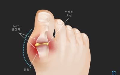 통풍이미지