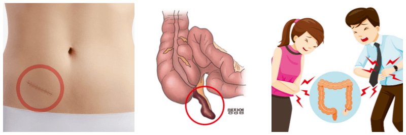 맹장염 위치, 맹장염, 복통 사진
