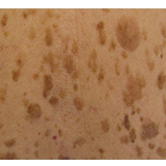 기미 없애는 방법