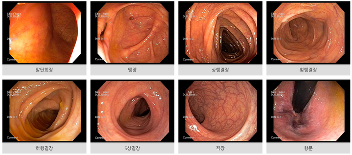 대장내시경 모습