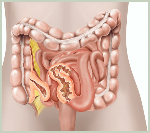 크론병 원인과 증상