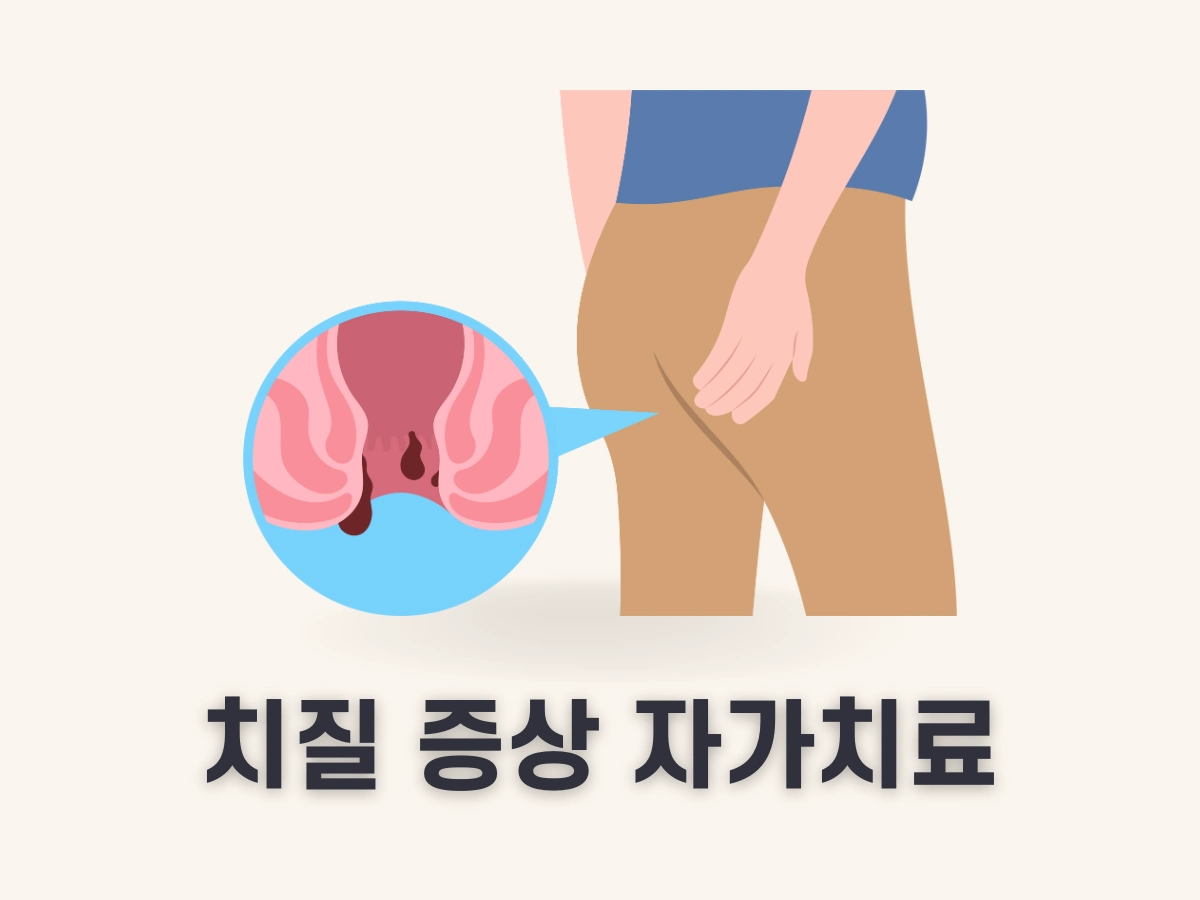 치질 증상 자가치료
