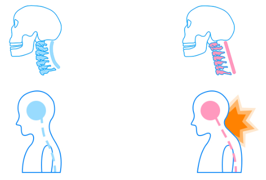 목디스크로 인한 어깨결림