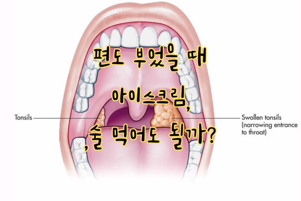 편도 부었을 때 아이스크림 술
