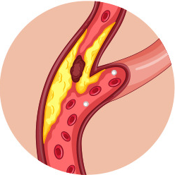 고지혈증에 좋은 음식
